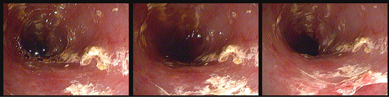 гастроскопия эзофагогастродуоденоскопия (ЭГДС)