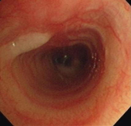 коллапс трахеи 1 степени