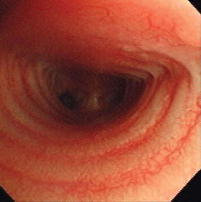 коллапс трахеи 2 степени