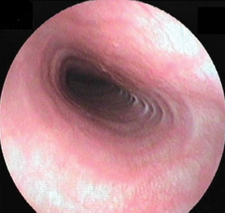 коллапс трахеи 3 степени